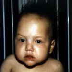 síndrome trico hepatoentérica