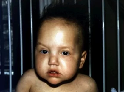 síndrome trico hepatoentérica