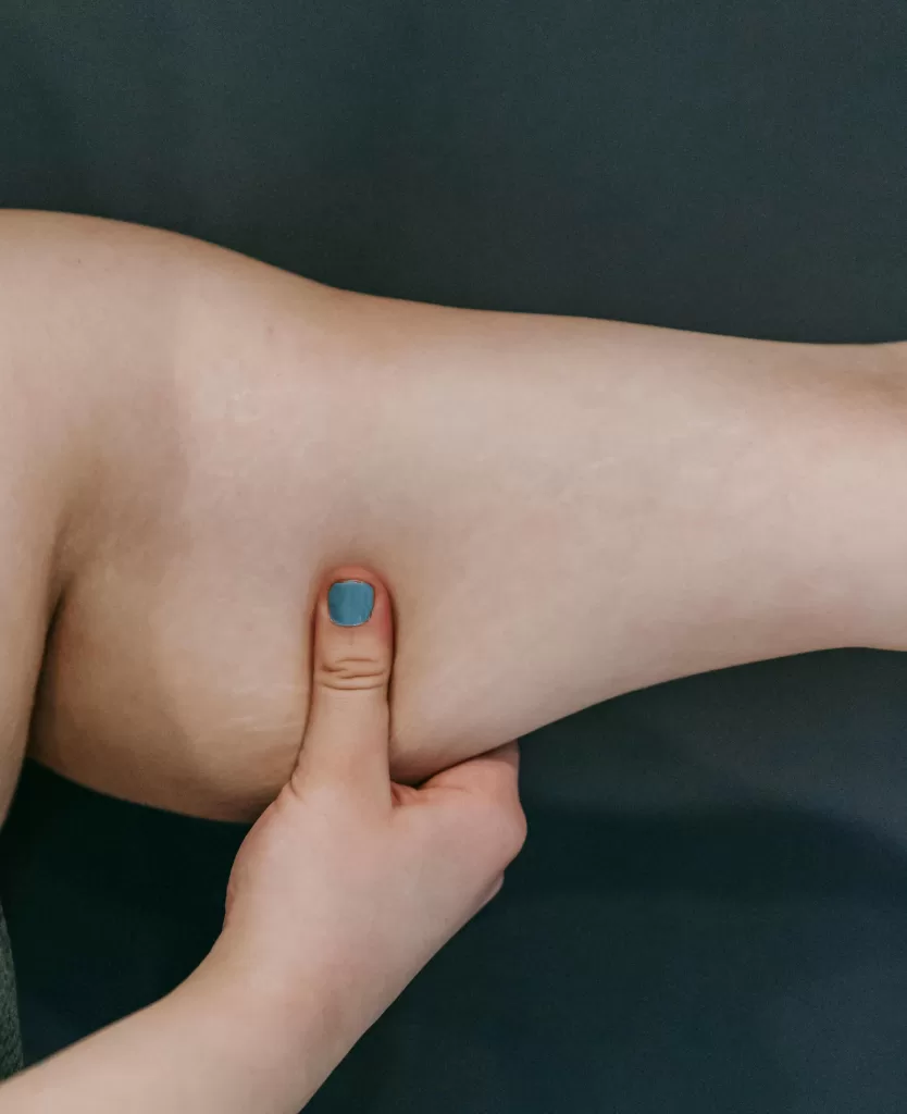 Flacidez após emagrecimento