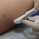 implante contraceptivo SUS