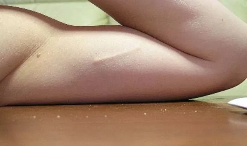 implante contraceptivo sus