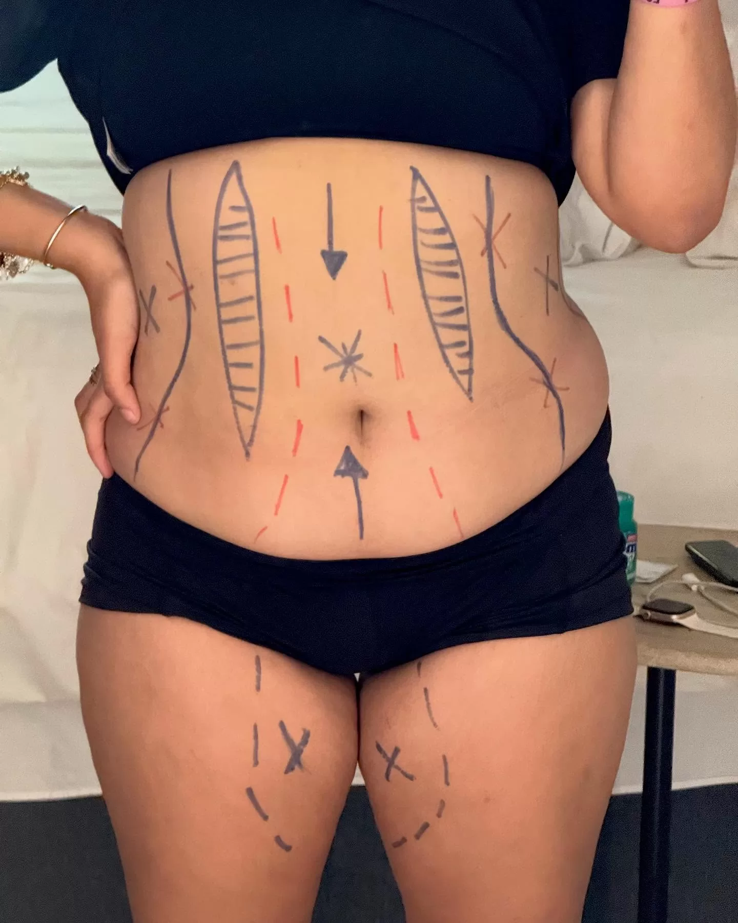 Saiba como o caso de Emilly Vick fez lipoaspiração revela a pressão estética sobre influenciadores e a população. Descubra impactos psicológicos, padrões inalcançáveis e estratégias para lidar com essa cobrança diária.