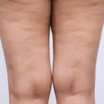 lipedema