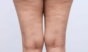 lipedema