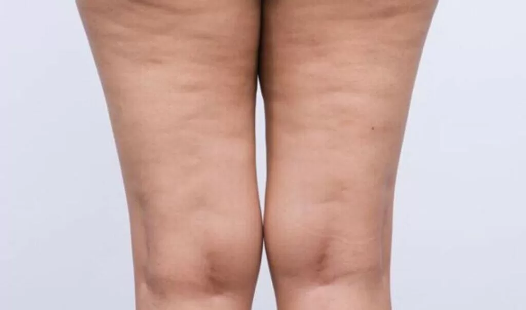 lipedema
